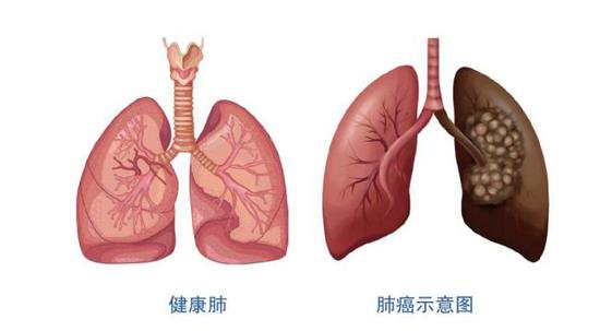 肺癌是<em>怎么得来的</em>？