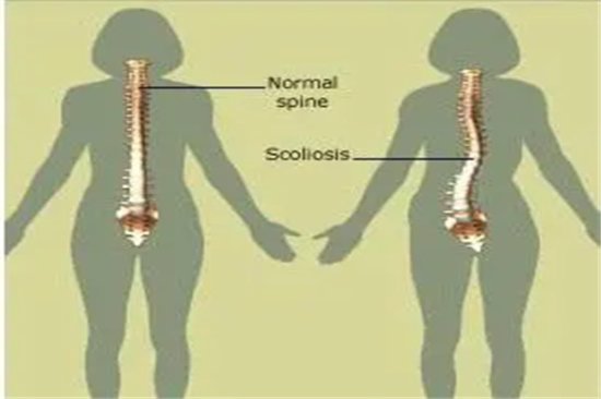 正骨可以<em>治疗脊柱</em>侧弯吗？取决于患者的侧弯严重程度