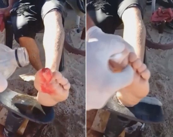 阿根廷一男子在河中游泳遭<em>食人鱼</em>袭击 被咬掉大脚趾