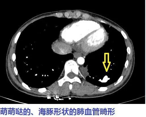 肺部CT平扫发现海豚样、<em>蚯蚓</em>状改变……警惕这个地雷！