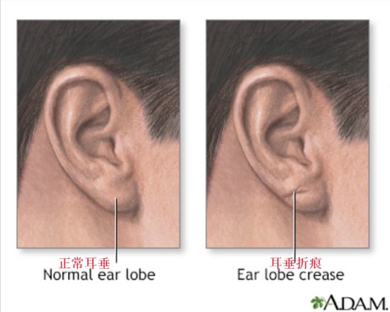 什么是耳垂褶皱症？耳垂褶皱与心血管<em>疾病有什么</em>关系？