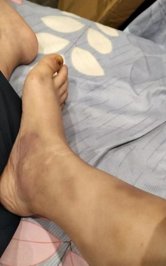 晨意帮忙丨湖南女子上班脚趾被砸，报销120元治疗费被拒？