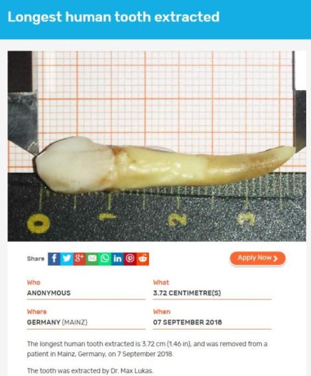 长3.72厘米！德国牙医因给患者拔了这颗牙创世界纪录-中新网