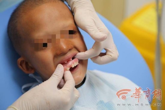 <em>小孩缺</em>牙家长千万别大意！6岁男孩只长4颗牙齿被诊断出罕见病