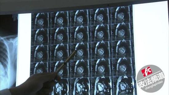 湖南一35岁女子10年间吃了30多种<em>减肥</em>药！CT扫描心脏影像惊人...