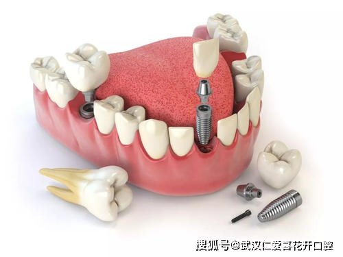 缺牙后选择<em>哪种</em>方法修复比较好？