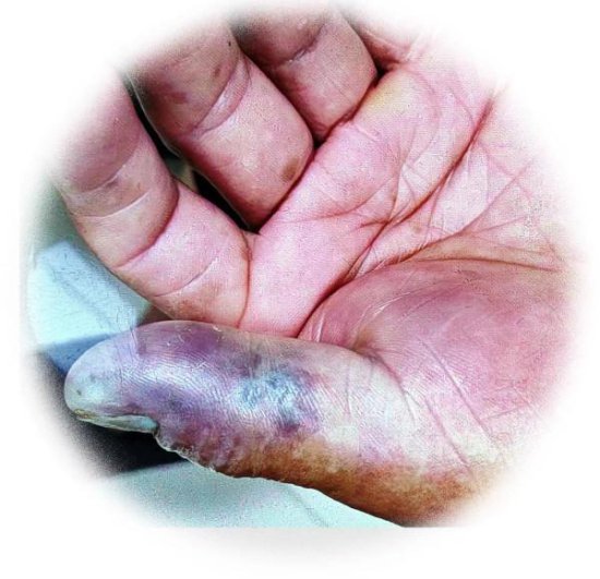 52岁杭州大伯洗小龙虾<em>手指</em>被刺伤，3天后多脏器衰竭离世