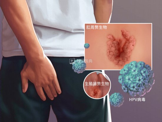<em>身上</em>这4种<em>皮肤</em>疙瘩，要当心HPV感染