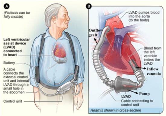 没有心跳也能正常生活！国产全磁悬浮人工心脏，到底有多神奇？