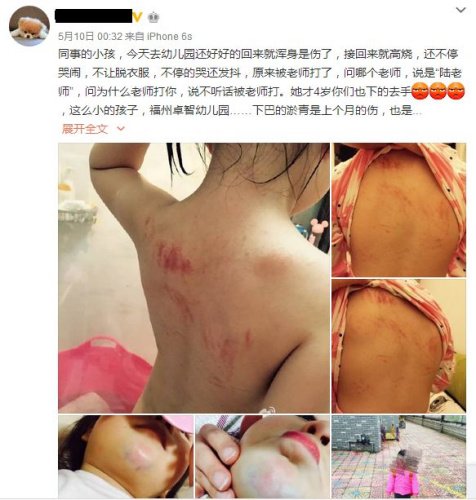 网曝3岁<em>女孩</em>在幼儿园被老师打伤 警方正调查