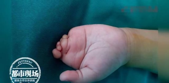 孩子<em>出生</em>左手只有1根手指！医生用这招，2年后手指长出来了