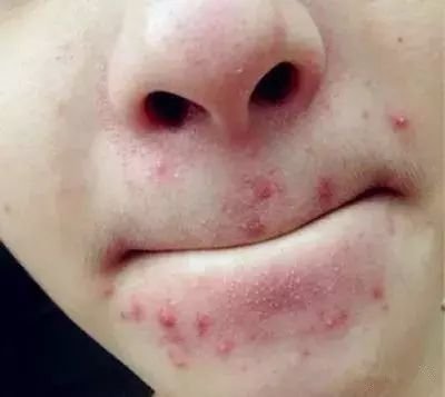 <em>嘴巴周围长</em>痘痘是怎么回事？