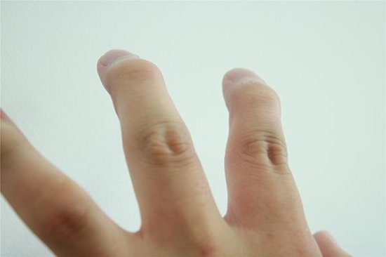 <em>手指无故</em>肿了起来？也许是“疾病”给的暗示，别坐视不理